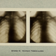 Image for article titled A Town in Rural Alabama Has a Tuberculosis Incidence Rate That Approaches Somalia's